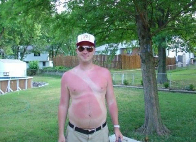 Examples When People Forgot They Can Actually Get Sunburns If They Don Examples When People Forgot They Can Actually Get Sunburns If They Don