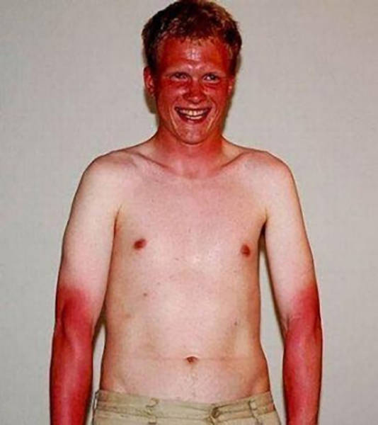 Examples When People Forgot They Can Actually Get Sunburns If They Don Examples When People Forgot They Can Actually Get Sunburns If They Don