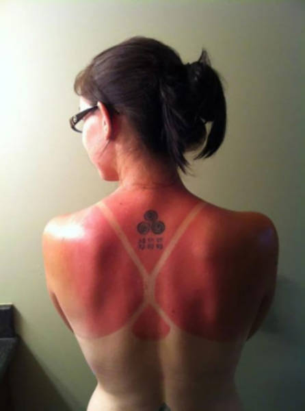 Examples When People Forgot They Can Actually Get Sunburns If They Don Examples When People Forgot They Can Actually Get Sunburns If They Don