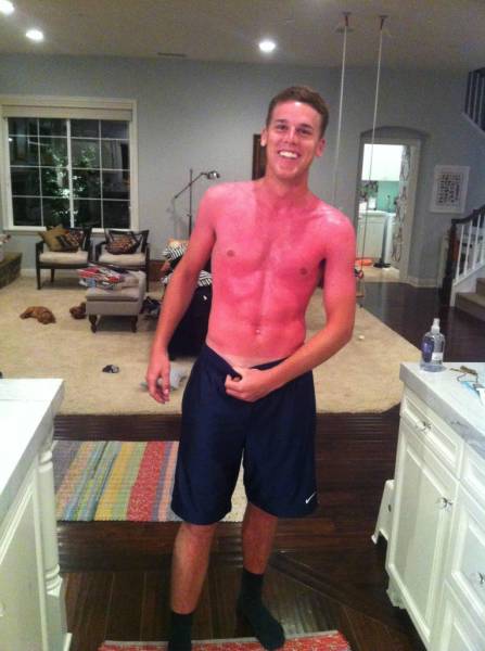 Examples When People Forgot They Can Actually Get Sunburns If They Don Examples When People Forgot They Can Actually Get Sunburns If They Don