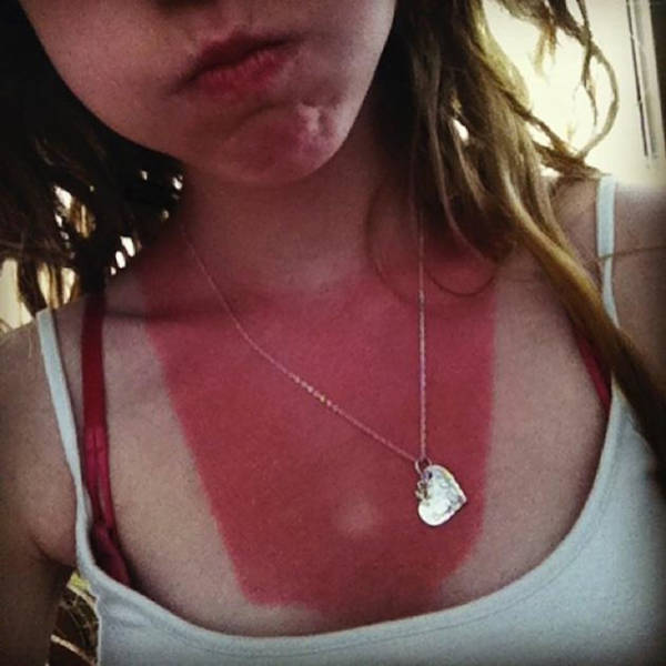 Examples When People Forgot They Can Actually Get Sunburns If They Don Examples When People Forgot They Can Actually Get Sunburns If They Don