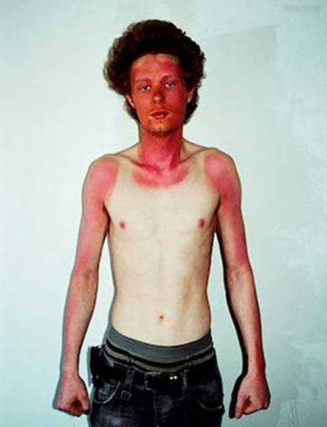 Examples When People Forgot They Can Actually Get Sunburns If They Don Examples When People Forgot They Can Actually Get Sunburns If They Don