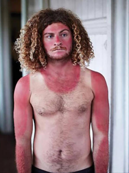 Examples When People Forgot They Can Actually Get Sunburns If They Don Examples When People Forgot They Can Actually Get Sunburns If They Don