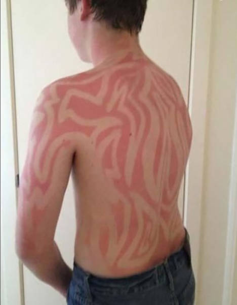 Examples When People Forgot They Can Actually Get Sunburns If They Don Examples When People Forgot They Can Actually Get Sunburns If They Don