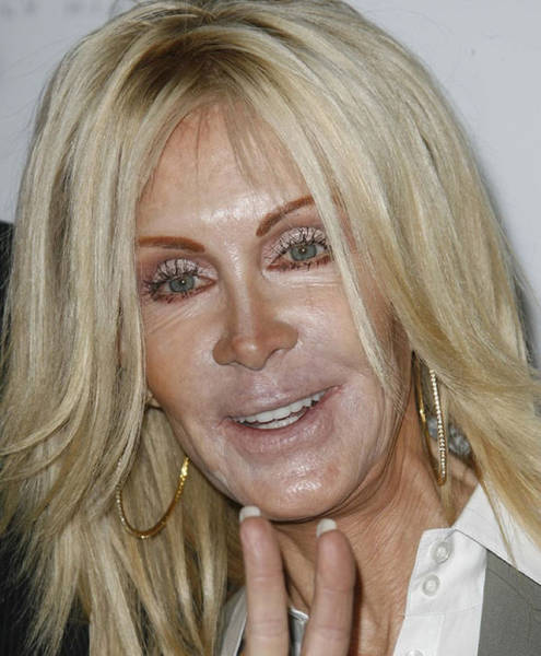 When The Plastic Surgery Fails Irreversibly