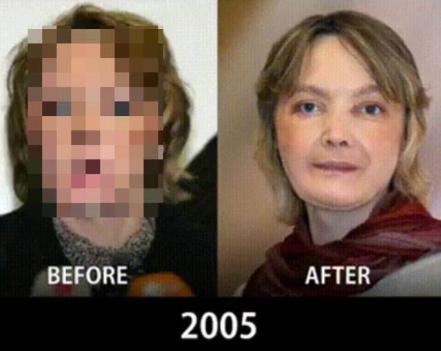 Face Transplantation Is Getting More And More Perfect Each Year