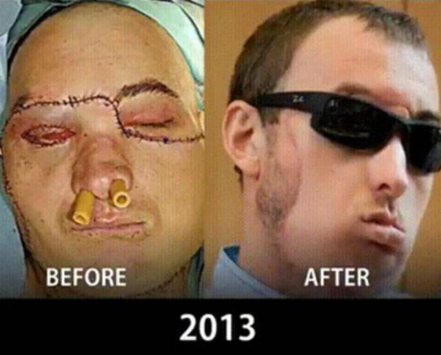 Face Transplantation Is Getting More And More Perfect Each Year