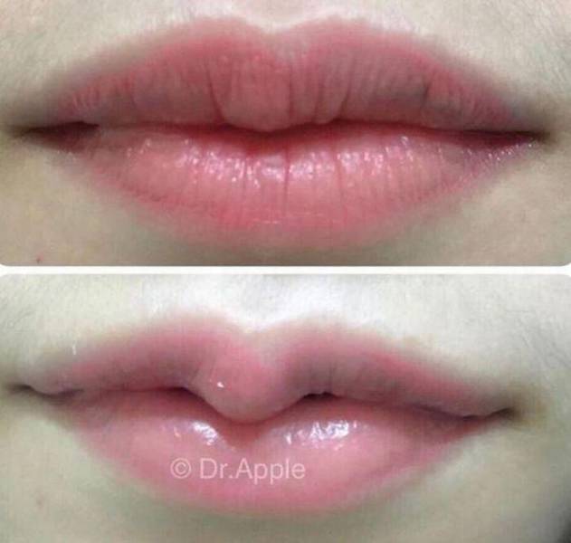 Thai Girls Are Massively Joining The Trend Of Making Their Lips Look Like Turtle Beaks