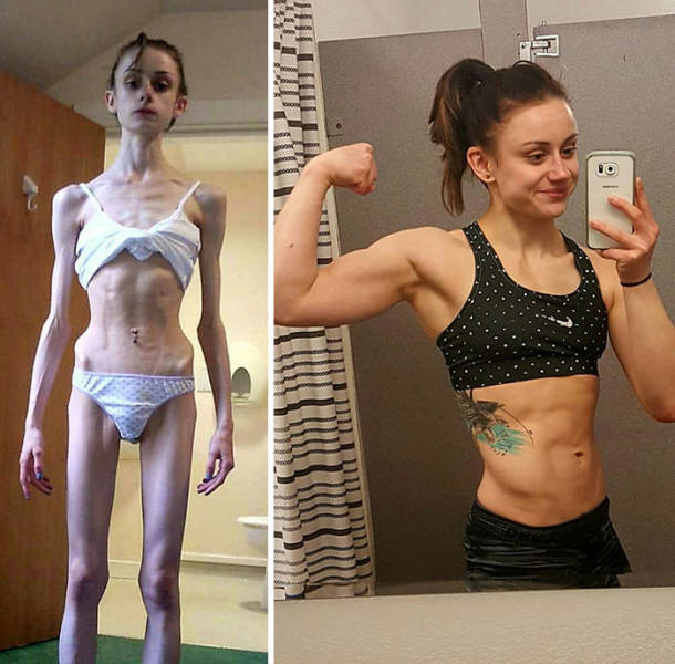 Anorexia Is Not The Final Verdict!