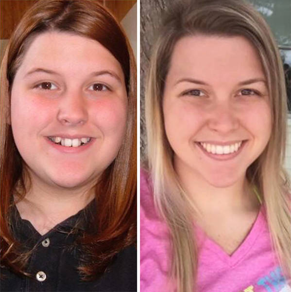 Braces Can Do Wonders With People’s Smiles!