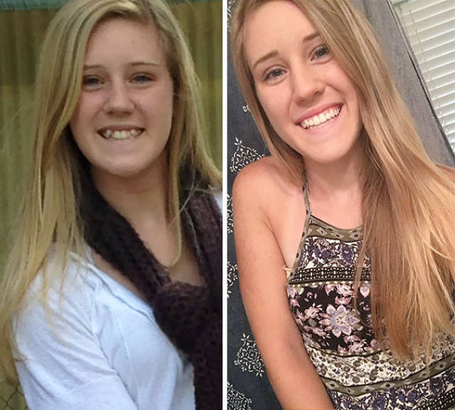 Braces Can Do Wonders With People’s Smiles!