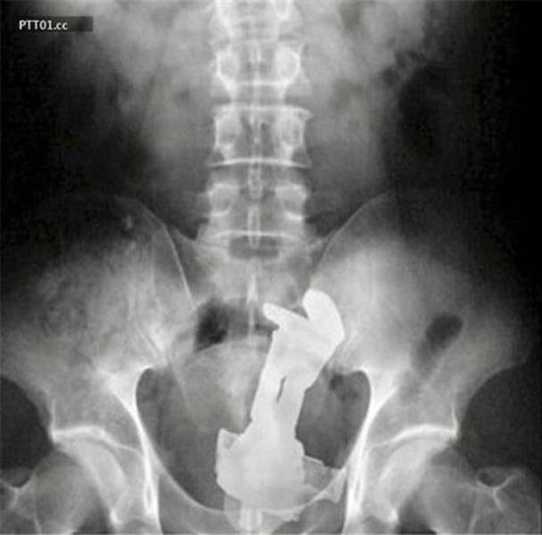 Sometimes, X-Rays Show What You Don’t Want To See