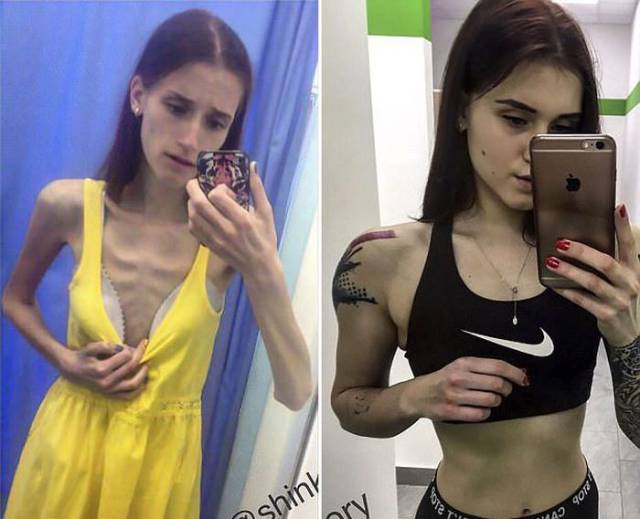 This Russian Teen Has Proved That Anorexia Can’t Stop You
