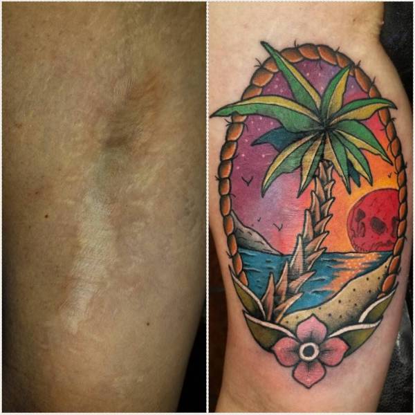 Awful Scars Can Be Covered With Beautiful Tattoos