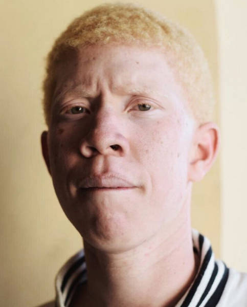 How Albinos From Various Races Look Like