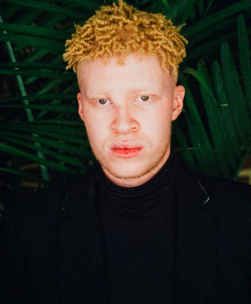 How Albinos From Various Races Look Like