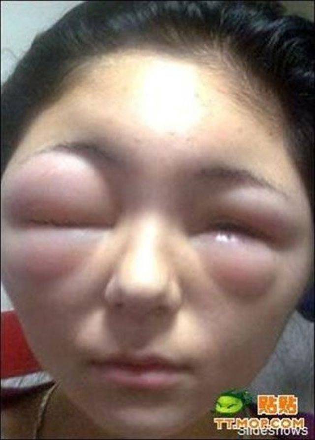 When Allergy Strikes