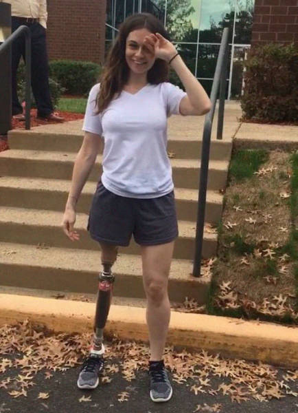 She Has Defeated Cancer, Had Her Leg Amputated, And Still It Never Stopped Her From Achieving Her Dreams