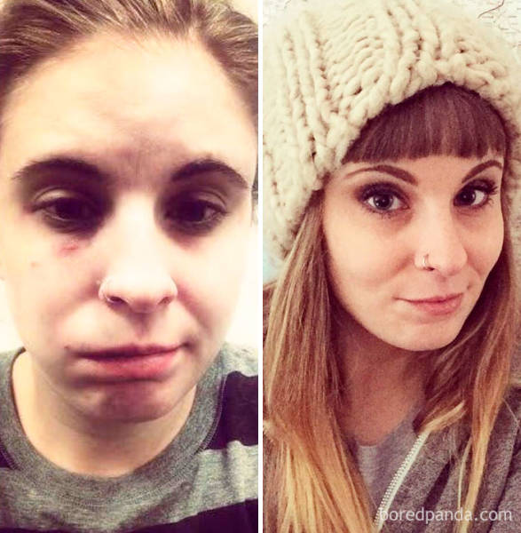 alcoholic face changes