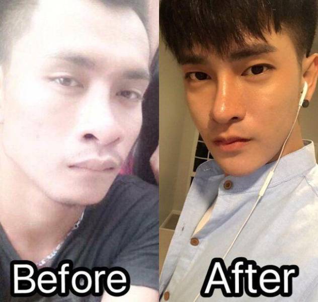 This Thai Man Desperately Wanted To Look Korean, So He Underwent 30 Cosmetic Procedures