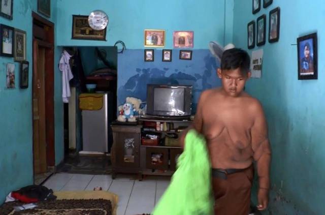 Indonesia’s Fattest Kid Is Now Only A Half Of His Past Self