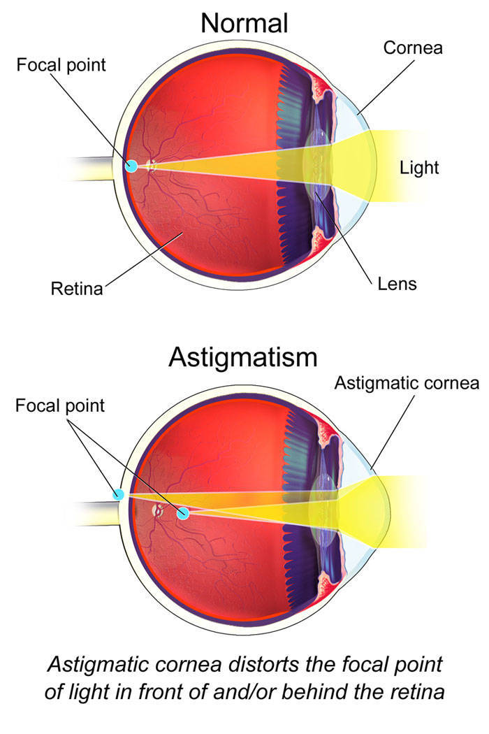 Do You Have Astigmatism? Here’s A Simple Test