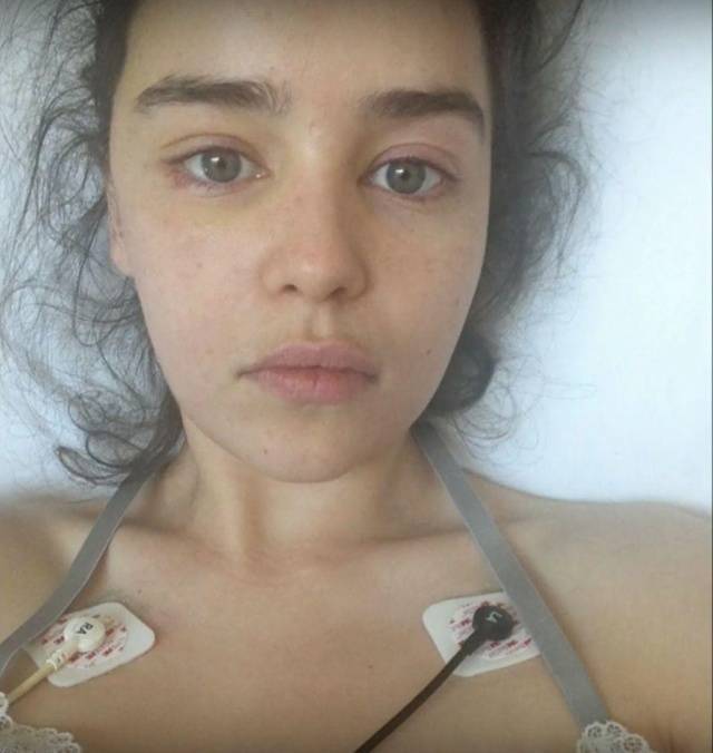 Emilia Clarke After Her Brain Aneurysm Treatment