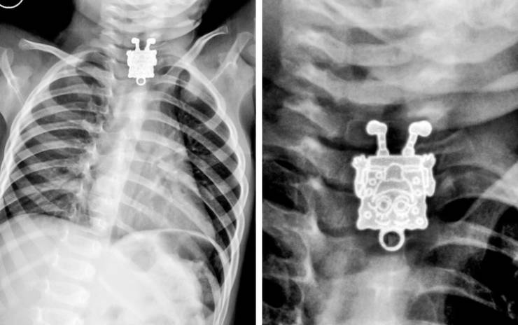 X-Rays Reveal Most Of Our Body’s Secrets