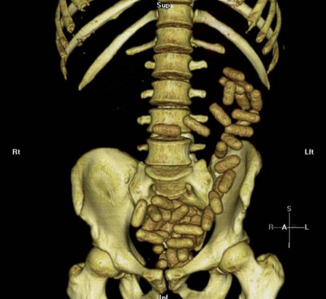 X-Rays Reveal Most Of Our Body’s Secrets