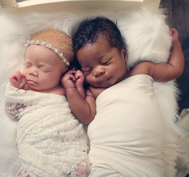 These Twins Have Different Skin Colors!
