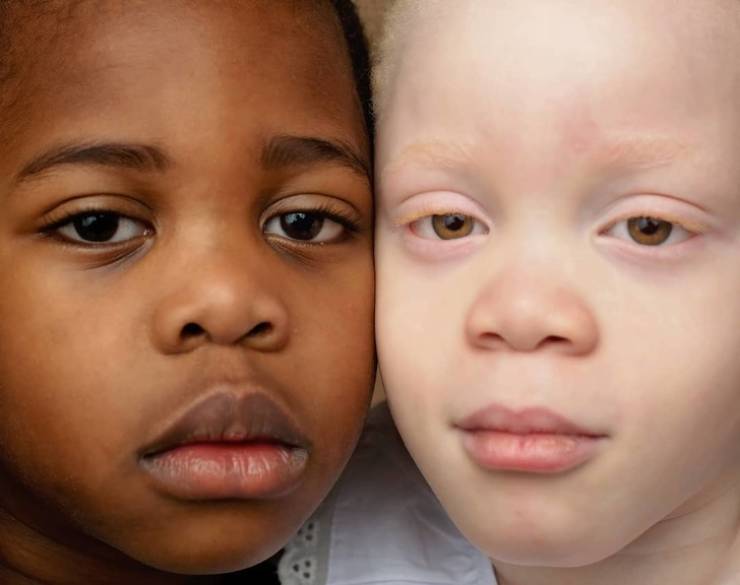 These Twins Have Different Skin Colors!
