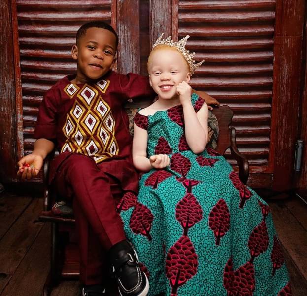 These Twins Have Different Skin Colors 15 Pics