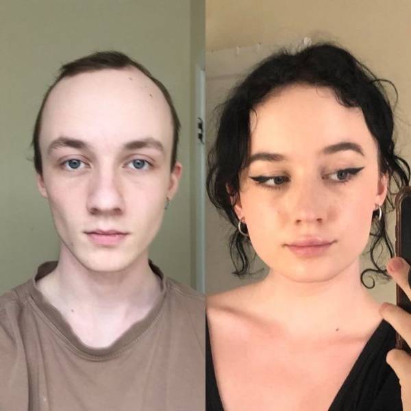 35 MTF) 8 months of HRT! Not doing much for my face but the hair regrowth  is real : r/transtimelines