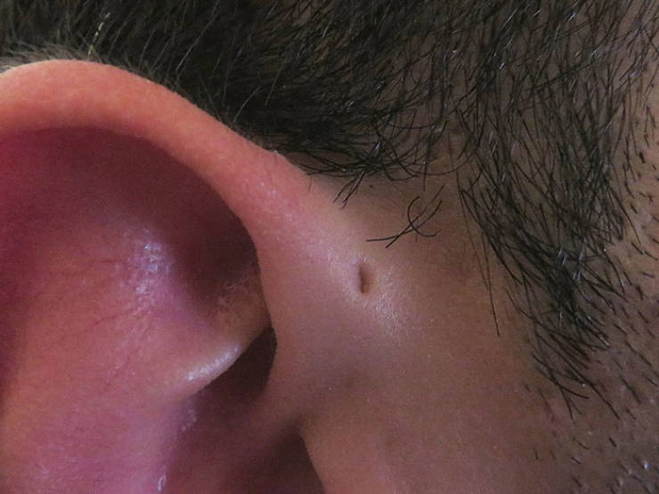 But What If That Tiny Hole Above Your Ear Serves A Purpose?