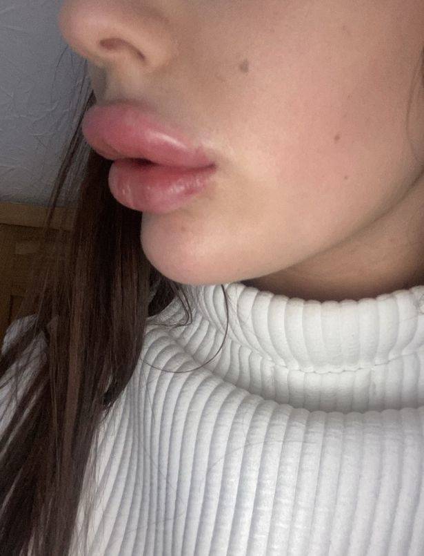 She Just Wanted Bigger Lips…
