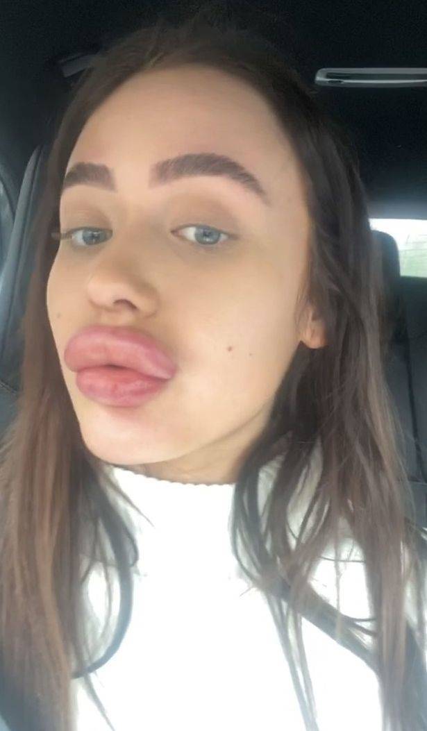 She Just Wanted Bigger Lips…