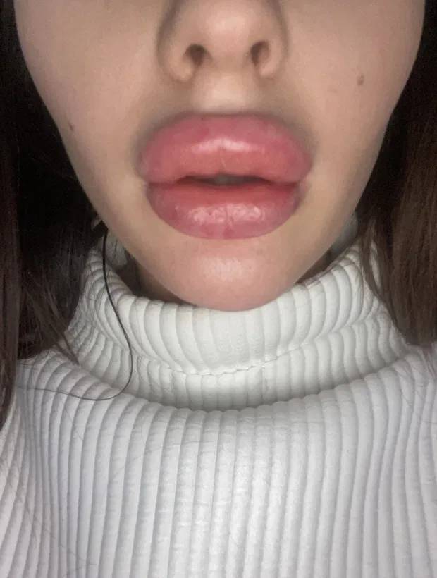 She Just Wanted Bigger Lips Pics Izismile Com