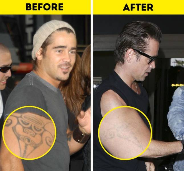 Celebs Who Got Rid Of Their Tattoos