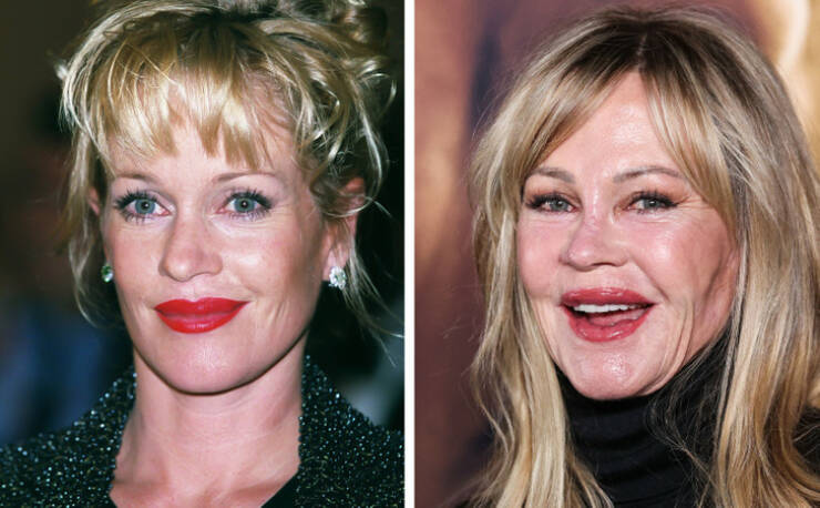Before And After: Celebrity Makeovers Through Plastic Surgery
