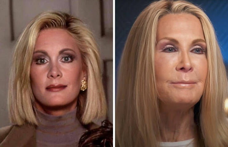 Famous Faces Before And After: The Impact of Cosmetic Surgery