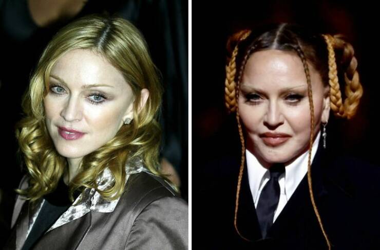 Famous Faces Before And After: The Impact of Cosmetic Surgery