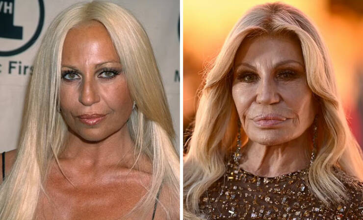 Famous Faces Before And After: The Impact of Cosmetic Surgery