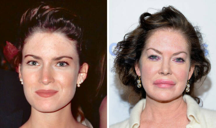 Famous Faces Before And After: The Impact of Cosmetic Surgery