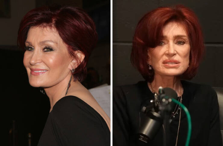Famous Faces Before And After: The Impact of Cosmetic Surgery