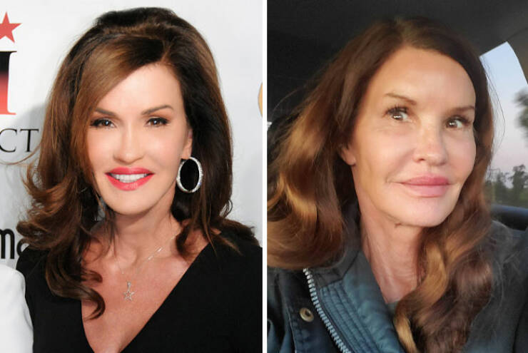 Famous Faces Before And After: The Impact of Cosmetic Surgery