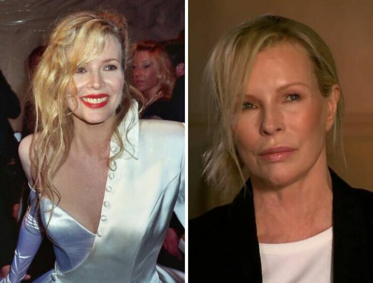 Famous Faces Before And After: The Impact of Cosmetic Surgery