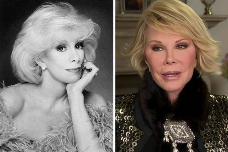 Famous Faces Before And After: The Impact of Cosmetic Surgery