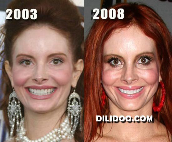 burn victims before and after plastic surgery