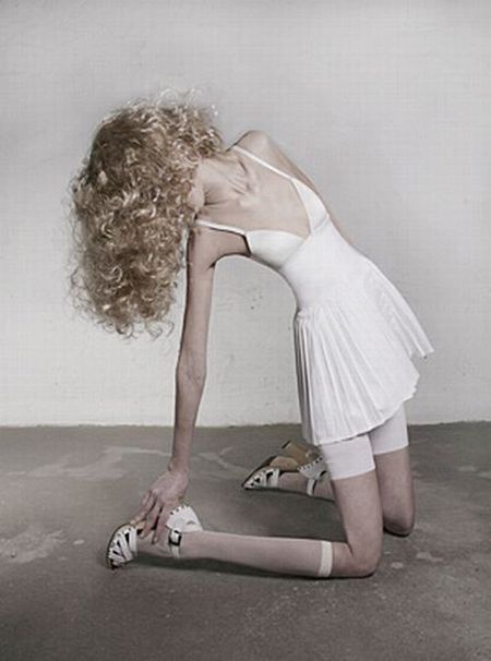 Anorexia It’s Terrifying 14 Pics