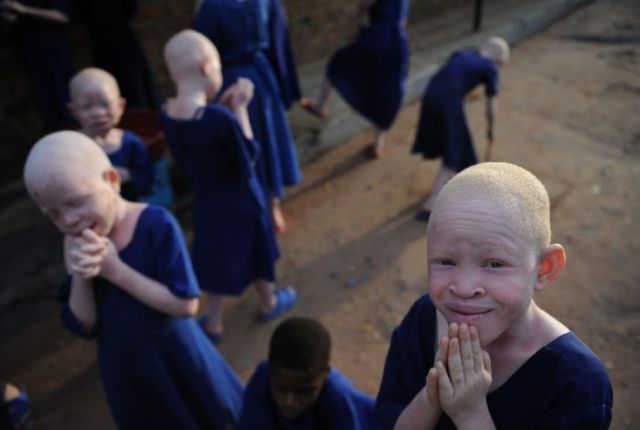 African Albinos (8 pics)